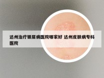 达州治疗银屑病医院哪家好 达州皮肤病专科医院