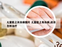 儿童脸上长白癣图片 儿童脸上有白癣,应该怎样治疗