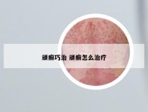 顽癣巧治 顽癣怎么治疗