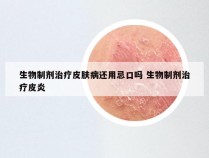 生物制剂治疗皮肤病还用忌口吗 生物制剂治疗皮炎