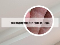 银屑病都是对称长么 银屑病一样吗