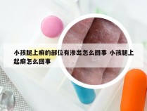 小孩腿上癣的部位有渗出怎么回事 小孩腿上起癣怎么回事