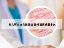 多久可以攻克银屑病 治疗银屑病要多久