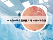 一块白一块白是癣图片吗 一块一块白斑