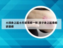 小孩身上起小片就像癣一样 孩子身上起像癣状很痒