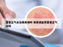 藿香正气水治银屑病吗 银屑病能擦藿香正气水吗