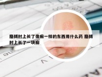 胳膊肘上长了像癣一样的东西用什么药 胳膊肘上长了一块癣