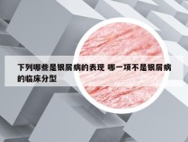 下列哪些是银屑病的表现 哪一项不是银屑病的临床分型