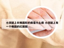 小孩腿上长椭圆形的癣是什么癣 小孩腿上有一个椭圆的红圈圈