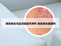 银屑病会引起双腿腿弯疼吗 银屑病会腿酸吗