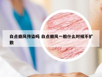 白点癫风传染吗 白点癫风一般什么时候不扩散