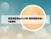 银屑病能做petcet吗 银屑病做皮肤ct准确吗