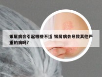 银屑病会引起哪些不适 银屑病会导致其他严重的病吗?