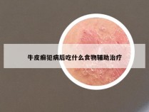 牛皮癣犯病后吃什么食物辅助治疗