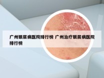 广州银屑病医院排行榜 广州治疗银屑病医院排行榜