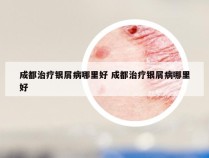 成都治疗银屑病哪里好 成都治疗银屑病哪里好