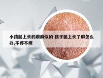 小孩腿上长的跟癣似的 孩子腿上长了癣怎么办,不疼不痒