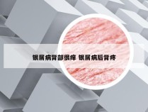 银屑病背部很痒 银屑病后背疼