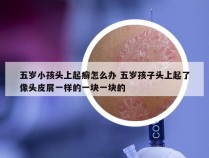 五岁小孩头上起癣怎么办 五岁孩子头上起了像头皮屑一样的一块一块的