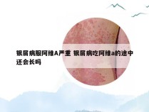 银屑病服阿维A严重 银屑病吃阿维a的途中还会长吗