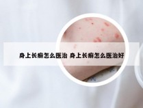 身上长癣怎么医治 身上长癣怎么医治好