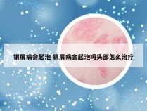 银屑病会起泡 银屑病会起泡吗头部怎么治疗