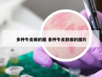 多种牛皮癣的图 各种牛皮肤癣的图片