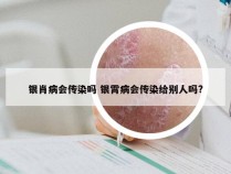 银肖病会传染吗 银霄病会传染给别人吗?