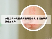 小腿上有一片像癣痒发硬是什么 小腿有块癣很痒怎么办