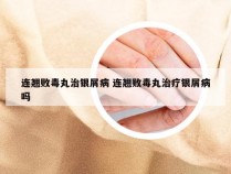 连翘败毒丸治银屑病 连翘败毒丸治疗银屑病吗