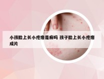 小孩脸上长小疙瘩是癣吗 孩子脸上长小疙瘩成片