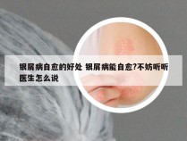 银屑病自愈的好处 银屑病能自愈?不妨听听医生怎么说