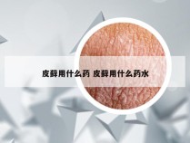 皮藓用什么药 皮藓用什么药水