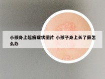 小孩身上起癣症状图片 小孩子身上长了藓怎么办