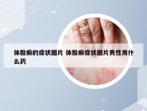 体股癣的症状图片 体股癣症状图片男性用什么药