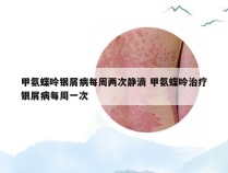 甲氨蝶呤银屑病每周两次静滴 甲氨蝶呤治疗银屑病每周一次