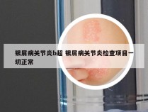 银屑病关节炎b超 银屑病关节炎检查项目一切正常