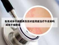 有用成体干细胞再生技术能彻底治疗牛皮癣吗 成体干细胞是