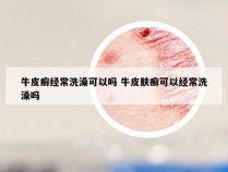 牛皮癣经常洗澡可以吗 牛皮肤癣可以经常洗澡吗