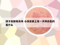 孩子皮肤有白块 小孩皮肤上有一大块白色的是什么