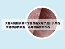 大腿大腿根内侧长了像皮癣又痒了是什么东西 大腿根部内侧有一小片跟癣似的东西