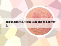 红皮银屑病什么不能吃 红皮银屑病不能吃什么