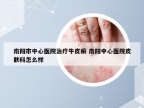 南阳市中心医院治疗牛皮癣 南阳中心医院皮肤科怎么样