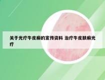 关于光疗牛皮癣的宣传资料 治疗牛皮肤癣光疗