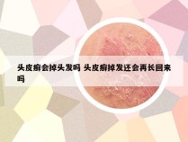 头皮癣会掉头发吗 头皮癣掉发还会再长回来吗