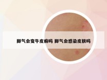 脚气会变牛皮癣吗 脚气会感染皮肤吗