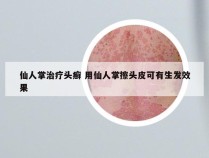 仙人掌治疗头癣 用仙人掌擦头皮可有生发效果