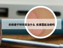 皮癣康宁特效膏治什么 皮康霜能治癣吗