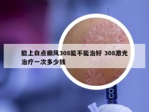 脸上白点癫风308能不能治好 308激光治疗一次多少钱