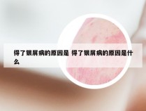 得了银屑病的原因是 得了银屑病的原因是什么